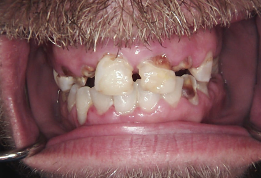 Frontal view of the patient’s initial smile showing advanced tooth decay and non-restorable anterior teeth.