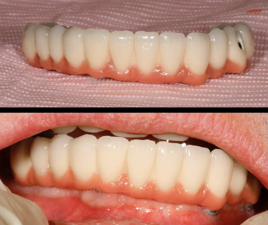 PFM mandible prosthesis with pink gingival base supported by four dental implants shown before and after placement