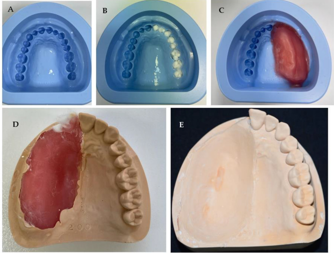 Laboratory steps of fabricating a plaster model of a unilateral maxillary defect, from silicone mold to the trimmed finished model.