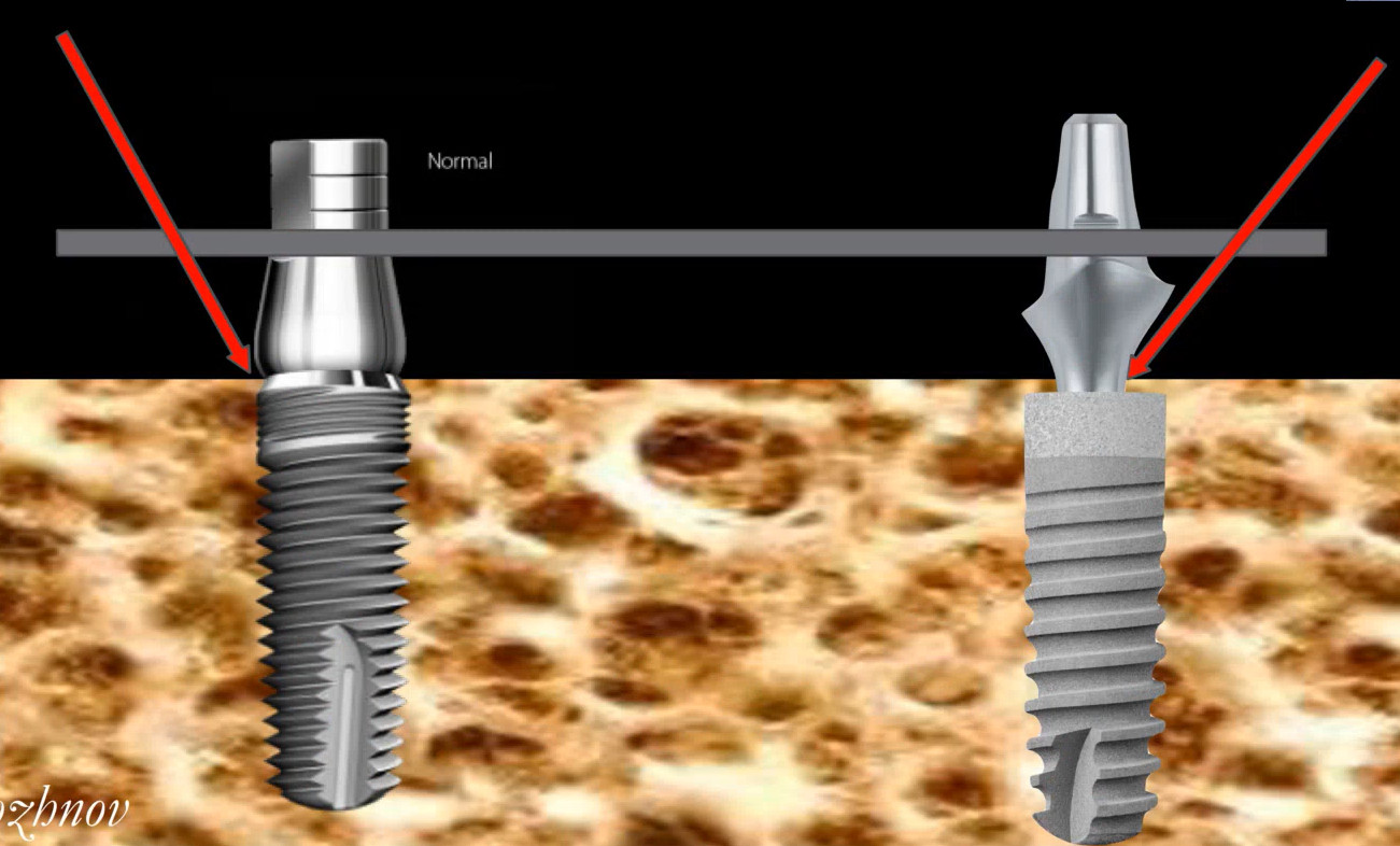 Diagram comparing crestal and subcrestal implant placement with platform switching.