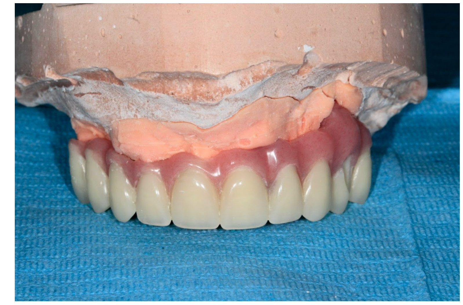 Full-arch PMMA prosthesis seated on a plaster cast model.