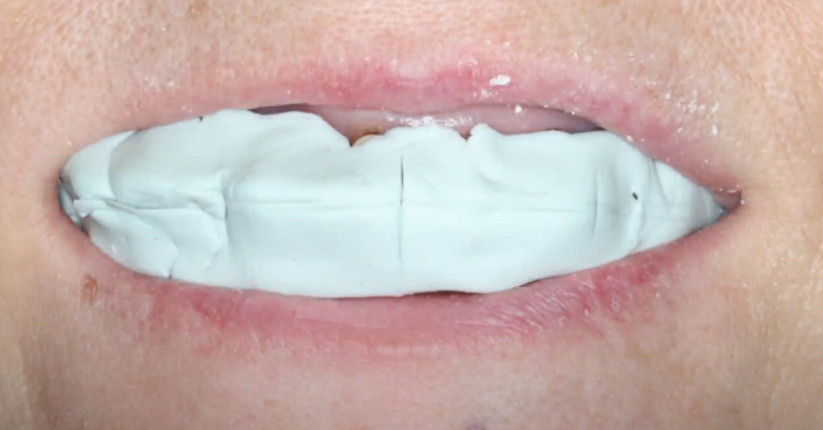 Making a cast to register the position of the jaws and the position of the dental arches YouTube / Dr. Kamil Khabiev / Dental Guru Academy