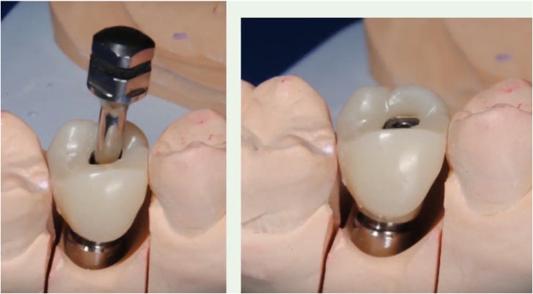 Provisional crown made of plastic