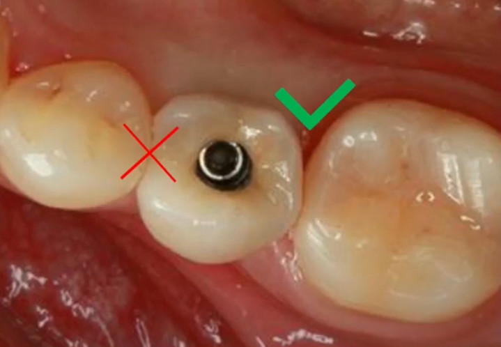 Incorrect (left) and correct (right) contact point between a restoration and adjacent natural teeth