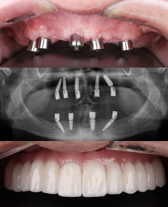 Restoring a dental arch with angled abutments and tilted implants from Shutterstock