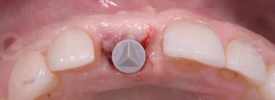 Occlusal view of the reopened implant site with the scan body attached.