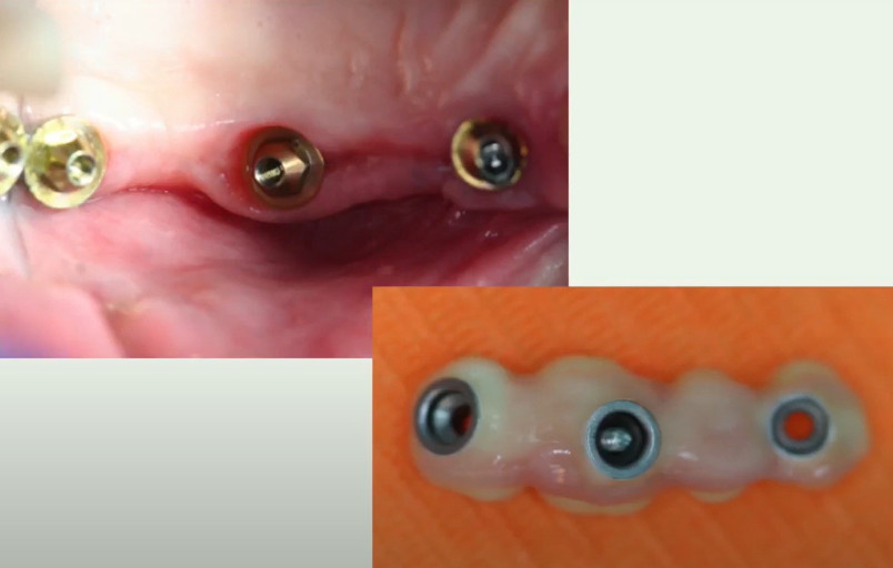 Screw-retained bridge on MUAs, compensating for significant implant angulation