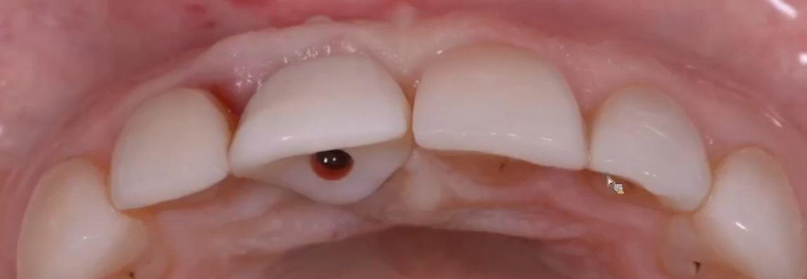 Frontal view of the screw-retained provisional crown showing close adaptation to the gingival margin.