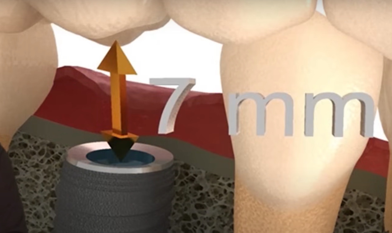 Direct indication for screw retention - the distance between the implant and the antagonist tooth is 7 mm or less