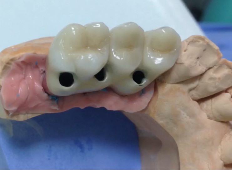 Screw retention supported by implants placed too palatally