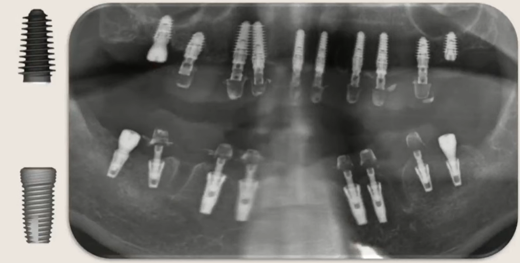 Selecting cancellous and cortical implants for the maxilla and mandible, respectively. (