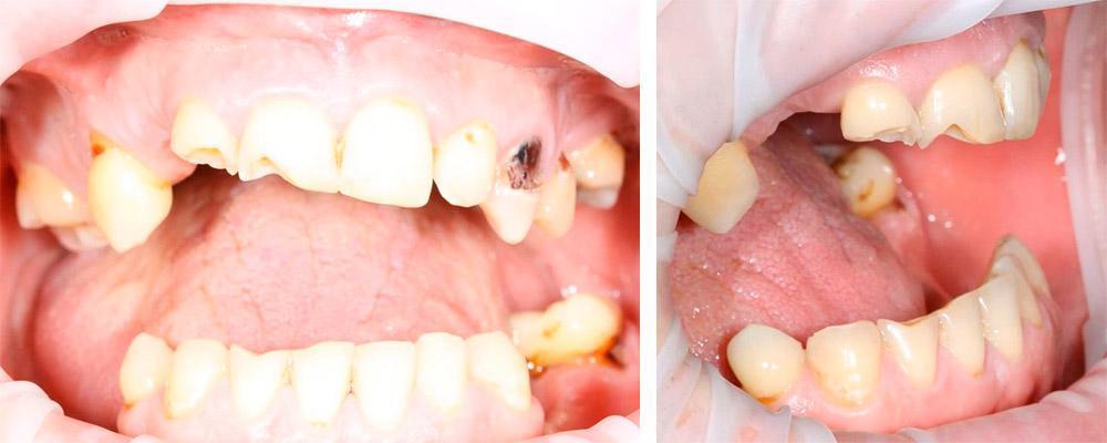 Severe dental arch deformity showing missing teeth, misalignment, and compromised bite requiring full-arch prosthetic rehabilitation