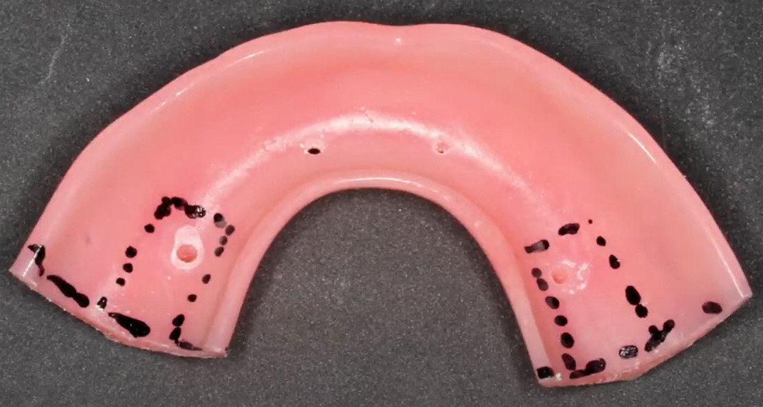 Marking the contact area of the temporary prosthesis with the mucosa