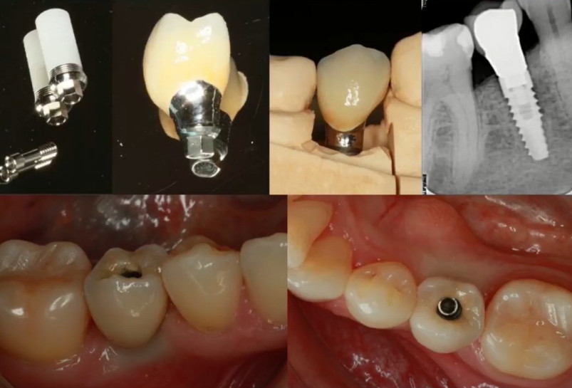 Single restoration at different stages of fabrication and fitting – contact point between premolar and prosthesis