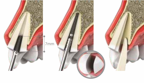 Recommendations of the standard implantation protocol using the Socket Shield technique