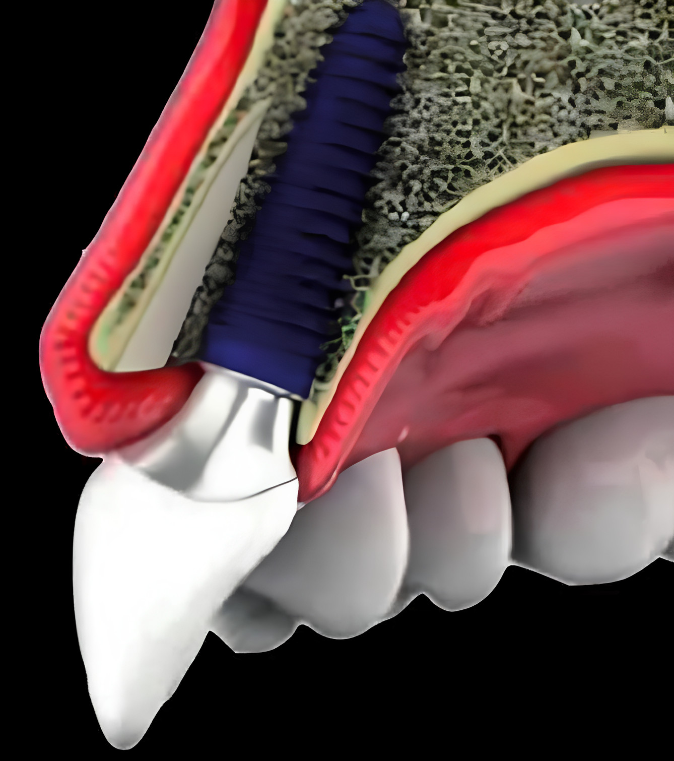 Implant placement using Socket Shield Technique