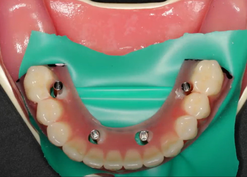 Stabilizing the prosthesis