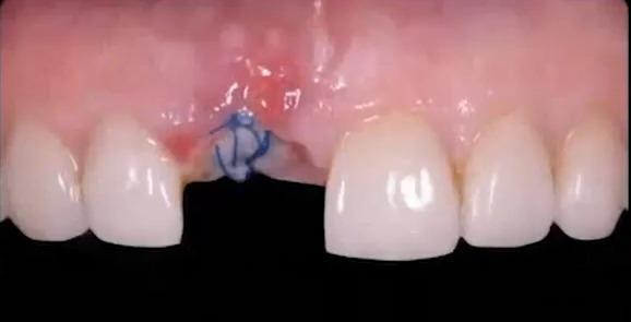 Close-up of the surgical site at the start of healing with sutures and the soft tissue graft visible.