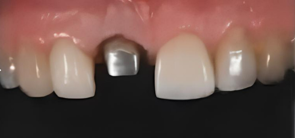 Frontal view of the anterior teeth after veneer correction with the post-and-core on tooth 11 still uncovered.