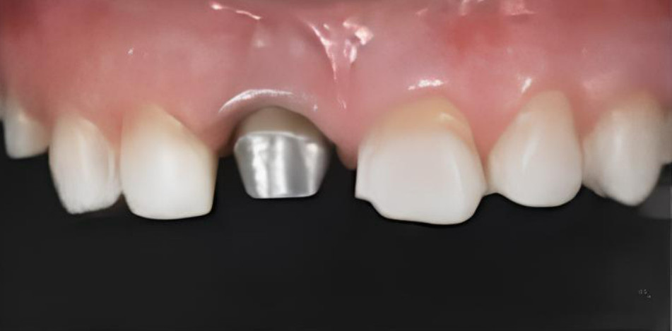 Close-up of bonded veneers adjacent to tooth 11 with the prepared metal post-and-core exposed for the future crown.
