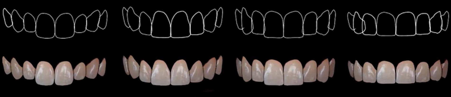 Four sets of upper anterior teeth showing different tooth shapes and gingival contours with outline diagrams above each set