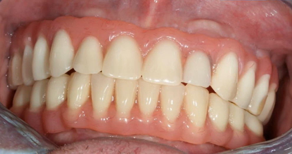Completed Toronto Bridge prosthesis showing full arch restoration with natural-looking teeth in patient's mouth