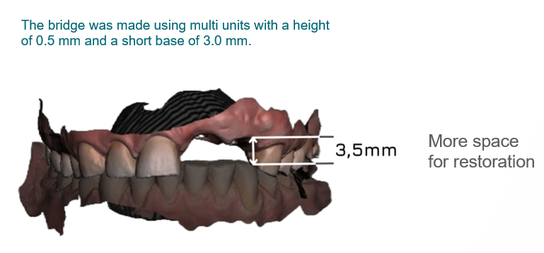 Digital model showing ultra-low profile dental implant bridge with 3.5mm vertical restoration space
