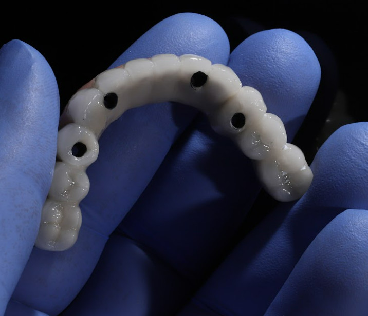 Example of zirconia bridge with screw access channels