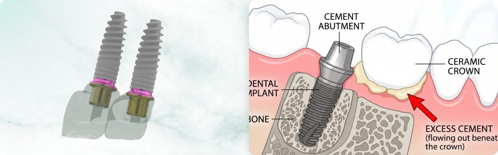 Cement or Screw Retention for Implant Prosthetics