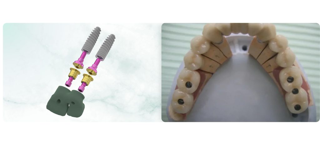 Cement or Screw Retention for Implant Prosthetics. Part 2