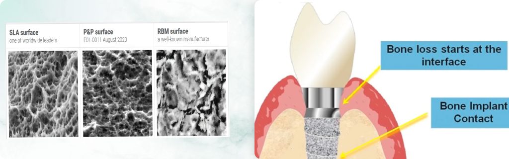 A Review of Dental Implant Surface Coatings and Their Impact on Healing Rates