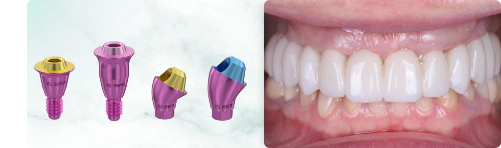 Total Maxillary Rehabilitation: Fixation of a Zirconia Prosthesis on V-Type and D-Type Multi-Unit Abutments